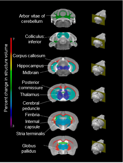 Volumetric differences seen in the brains of mice treated with anti-malarials with rosiglitazone compared to mice treated with anti-malarials alone.