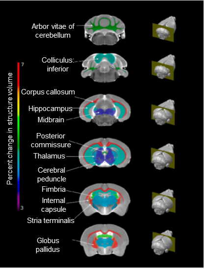 Volumetric differences seen in the brains of mice treated with anti-malarials with rosiglitazone compared to mice treated with anti-malarials alone.