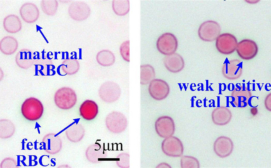 Identify fetal red blood cells in maternal blood for the diagnostics of Rhesus D hemolytic disease of the newborn (RhD HDN)